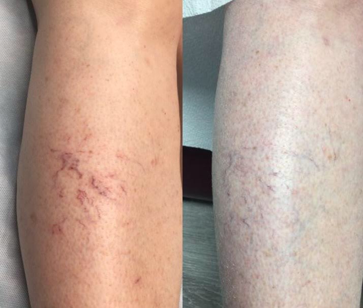 Sclerotherapy - Injection-Spa361 at The Dermatology and Skin Cancer Institute